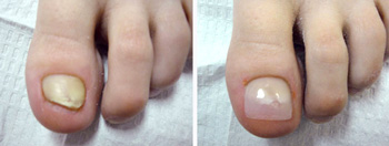 keryflex nail restoration treatment in Dothan, AL 36303 areas